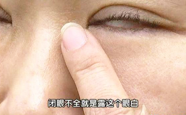 割雙眼皮后眼睛為什么閉不上?怎么修復(fù)?