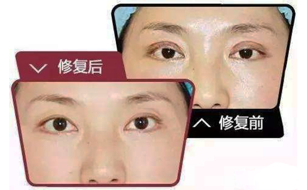 哪些情況需做雙眼皮修復(fù)？修復(fù)難度大不大?