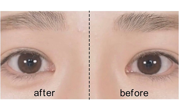 玻尿酸豐臥蠶術(shù)后怎么護(hù)理?哪些人不適合玻尿酸豐臥蠶?