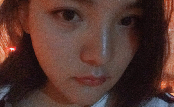 石家莊藍山杜建龍醫(yī)生下頜角整容手術(shù)案例術(shù)后兩個月