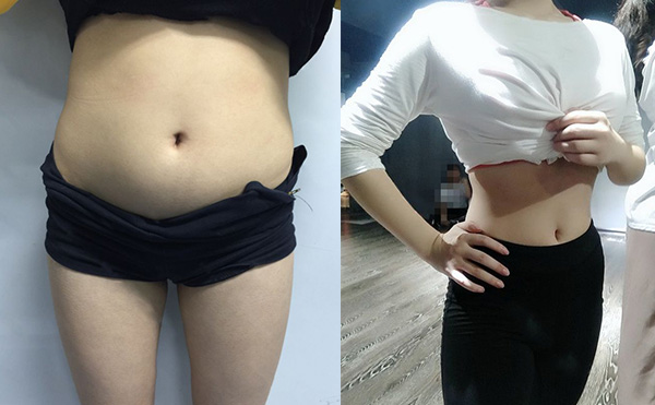 環(huán)吸抽脂有什么優(yōu)勢？