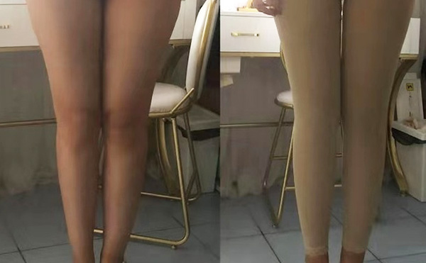 環(huán)吸抽脂疼不疼？