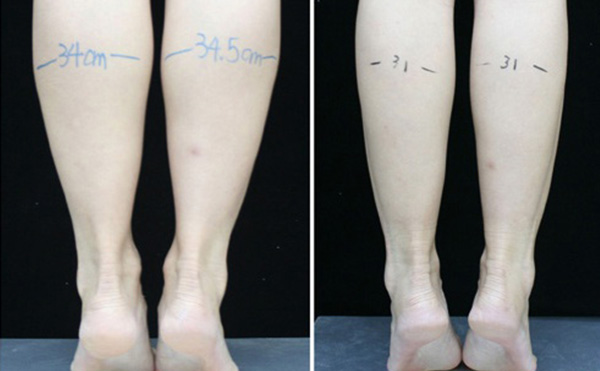 瘦腿針可以維持多長(zhǎng)時(shí)間？