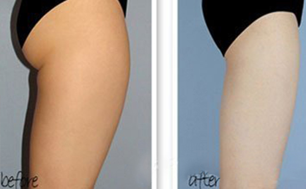 哪些人適合做臀部抽脂？