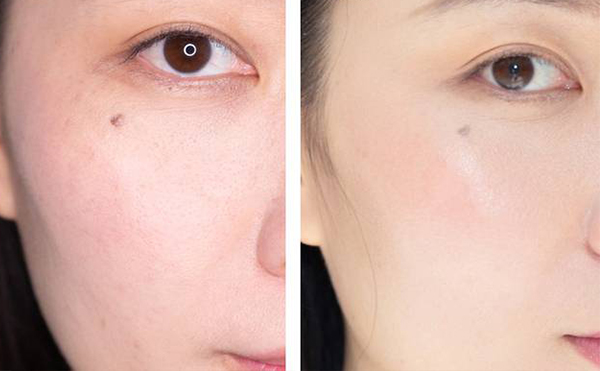 電波拉皮有哪些優(yōu)勢(shì)?做電波拉皮需要注意什么?