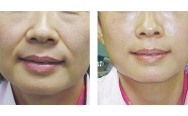 法令紋怎么形成的?怎么改善?