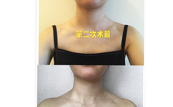 激光去除頸紋是什么原理?效果怎么樣?