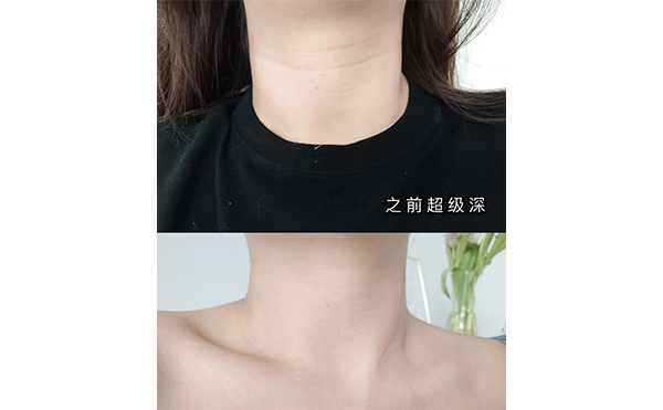 激光去頸紋適合哪些人？