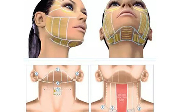 超聲刀怎么祛除頸紋？