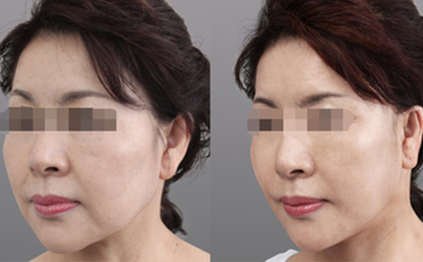 膠原蛋白除皺安全嗎?有沒(méi)有副作用?