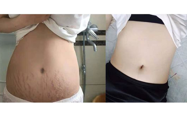 激光可以去除妊娠紋嗎？