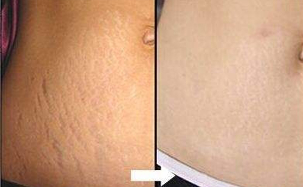 激光去妊娠紋幾次見效？