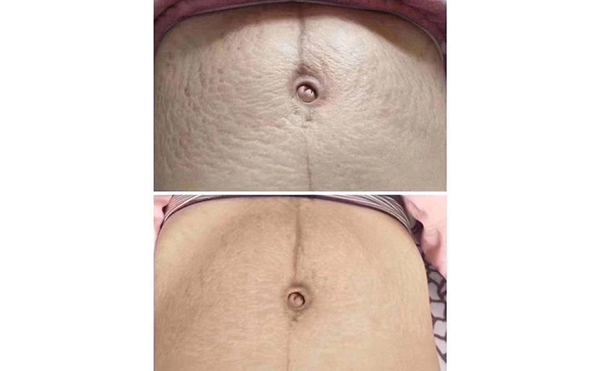 激光去妊辰紋多少錢？