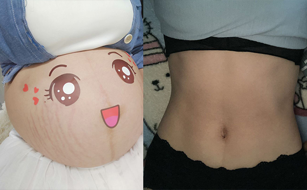 電波拉皮去除妊娠紋效果怎么樣？