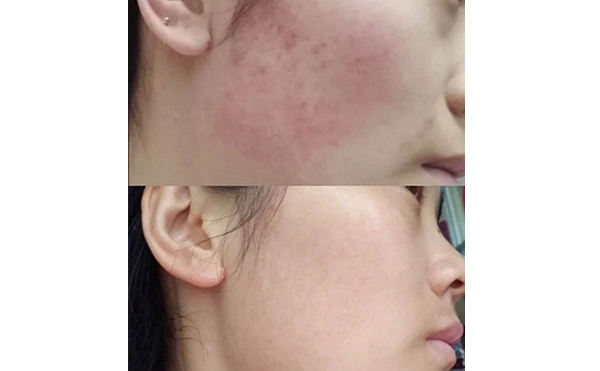 彩光嫩膚會讓皮膚變薄嗎？