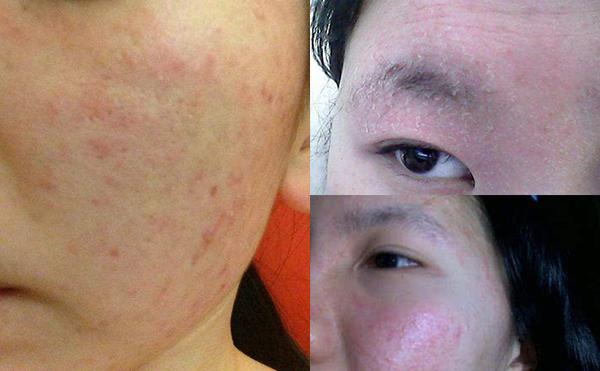 果酸煥膚安全嗎？