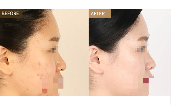 激光美白適合哪些人？