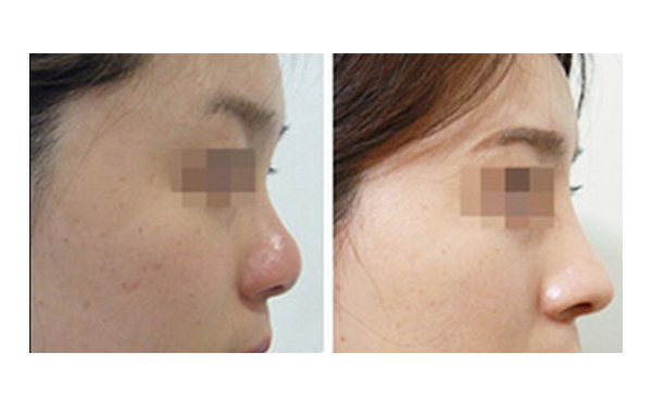 美白針和激光美白怎么選？