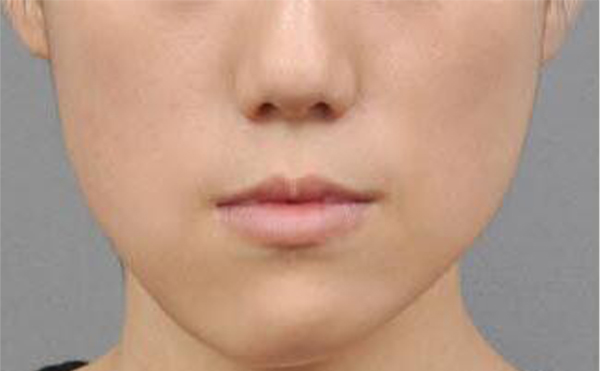 哪些小習(xí)慣會導(dǎo)致面部不對稱?