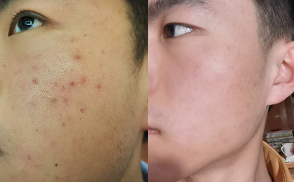 白瓷娃娃每次治療間隔多久？