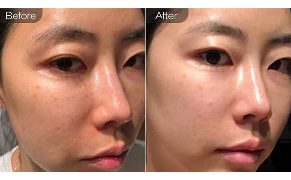 e光嫩膚是什么？