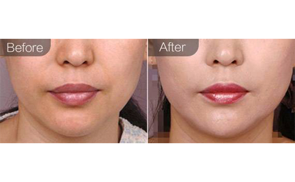 e光嫩膚有什么優(yōu)勢？