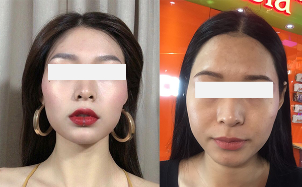 激光脫發(fā)際線效果怎么樣？