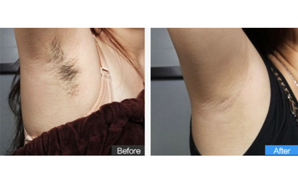 激光脫腋毛后多久能見(jiàn)效？
