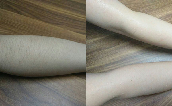 冰點(diǎn)手臂脫毛會(huì)傷害皮膚嗎？