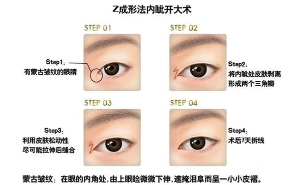 開(kāi)內(nèi)眼角復(fù)雜嗎?手術(shù)過(guò)程是什么?