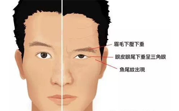 大小眼是什么原因造成的?大小眼怎么改善?