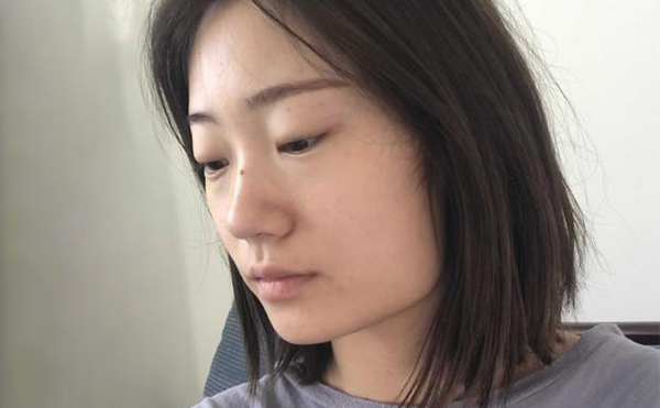 下頜角整形適宜人群有哪些？