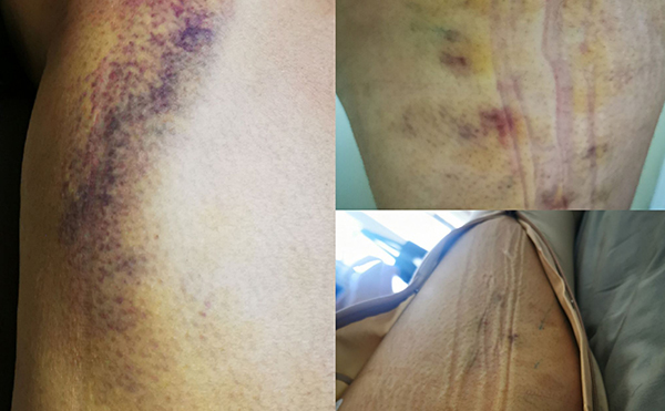 打瘦腿針有什么后遺癥嗎？