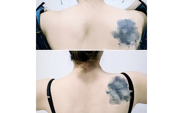 瘦肩針能維持多久？