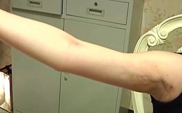 手臂吸脂有副作用嗎？