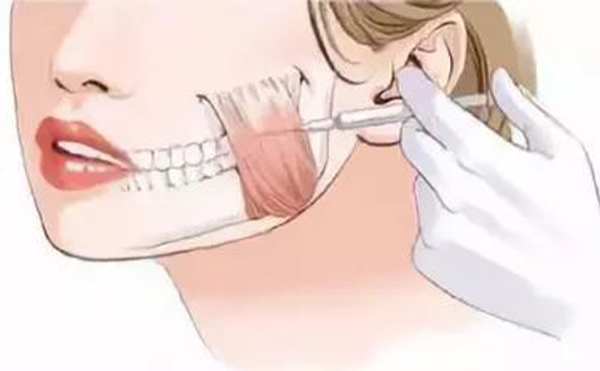 哪些小習(xí)慣會(huì)導(dǎo)致咬肌肥大？咬肌肥大怎么辦？