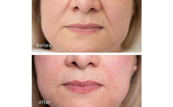 玻尿酸去法令紋安全嗎？