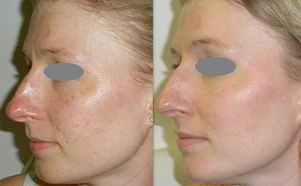 光子嫩膚價格受哪些因素影響？