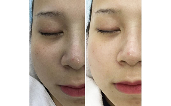 激光祛斑有哪些誤區(qū)？