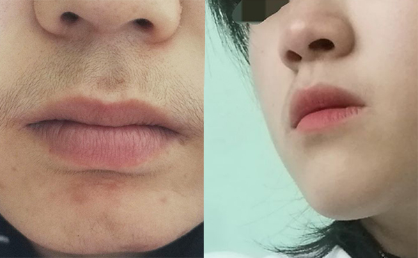 激光脫毛的效果怎么樣？