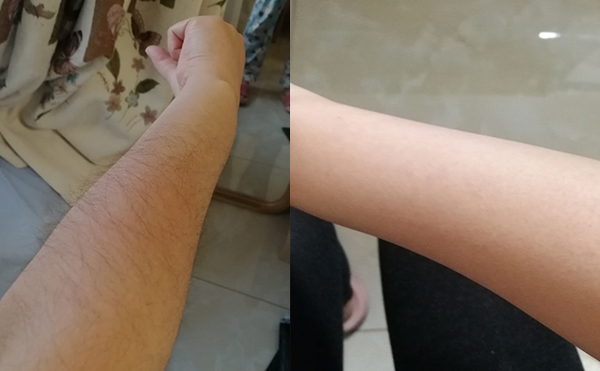 光子手臂脫毛幾次能脫完？