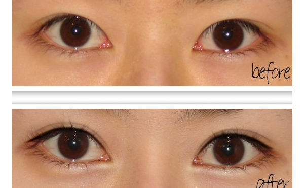 開(kāi)眼角手術(shù)有什么原則？