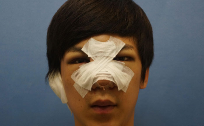 駝峰鼻矯正手術(shù)多少錢？駝峰鼻矯正有危險(xiǎn)嗎？