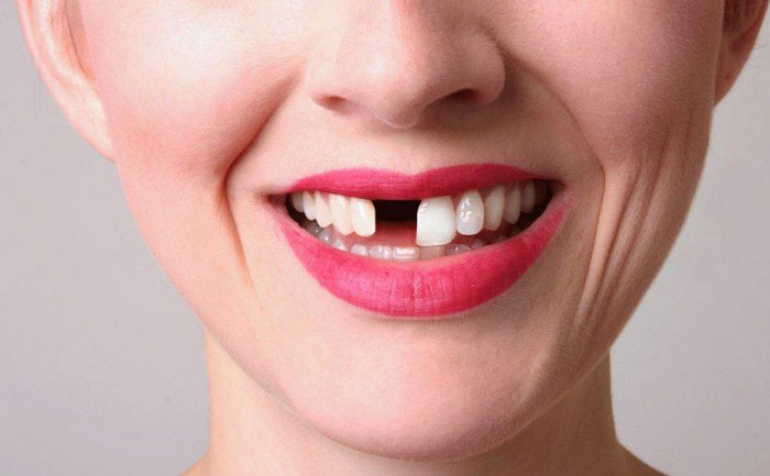 補門牙缺口大概多少錢？補門牙后一般能維持幾年？