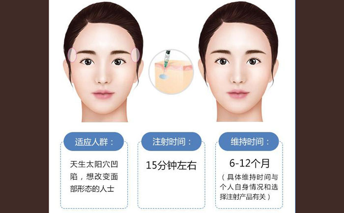 玻尿酸豐太陽穴一般幾支？