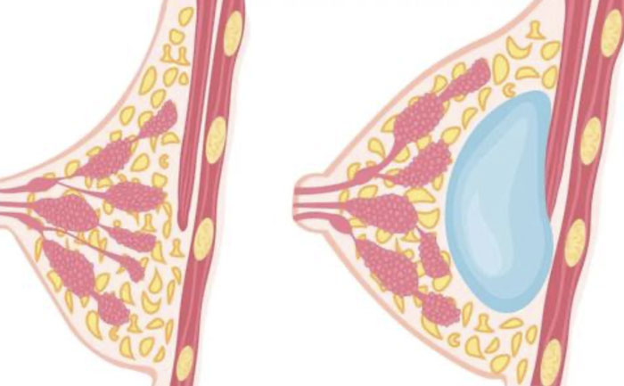 硅膠假體豐胸需要多少錢？硅膠假體豐胸可以保持多久？