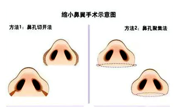  鼻翼縮小有后遺癥嗎？會不會反彈