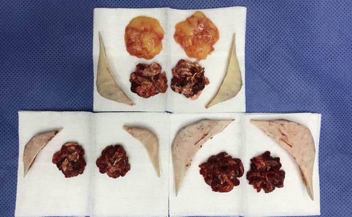 磨骨瘦臉費用多少錢？