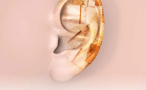 全耳再造術(shù)多少錢？全耳再造需要多久時(shí)間？