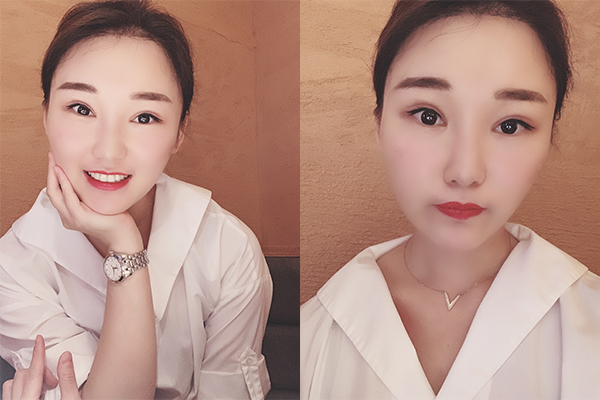 廣州韓非的李光琴院長面部精細化整形